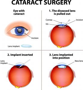 cataract surgery lens replacement. vision improvement.