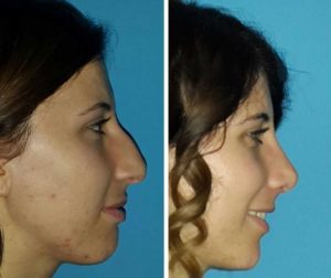 celebrity nose job explained. nose reshaping.
