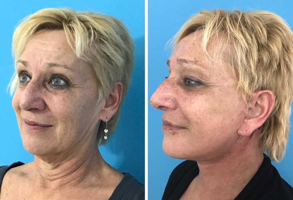Facelift Surgery All in Packages Up To 75 OFF in Turkey MedAway