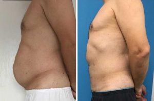 liposuction explained. what is liposuction?