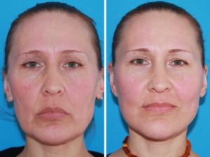 non surgical facelift explained. What is a non-surgical facelift? Botox, lip fillers, cheek fillers, chin fillers.