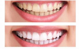 teeth whitening cost. How much does teeth whitening cost uk vs turkey?