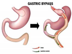 gastric bypass surgery weight loss surgery bariatric surgery