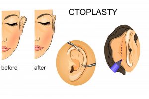 otoplasty ear correction surgery