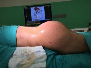 brazilian butt lift surgery turkey bbl before and after