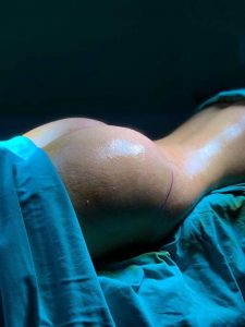 brazilian butt lift surgery turkey bbl before and after