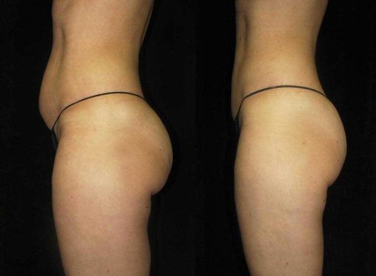 Vaser liposuction Turkey Vaser lipo before and after