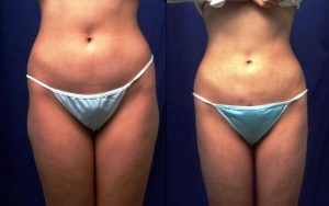 Vaser liposuction Turkey Vaser lipo before and after