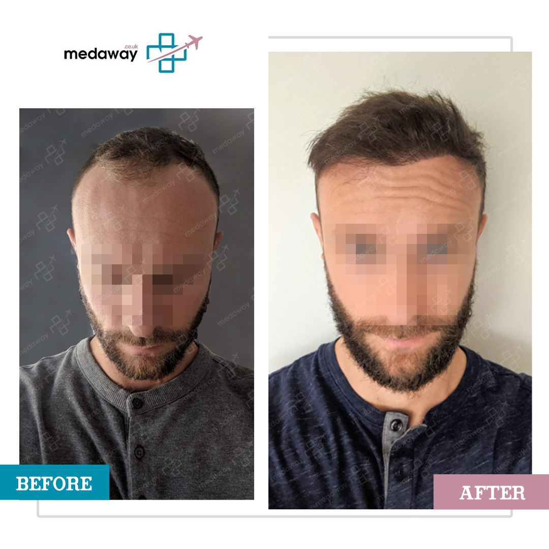 Hair Transplant Turkey Results: Before After