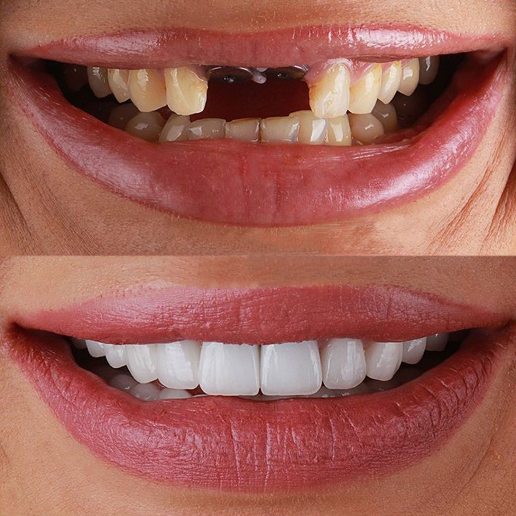 Dental Implants Before After 2