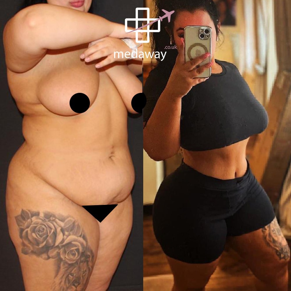 Medaway-Tummy-Tuck-10-min.jpeg