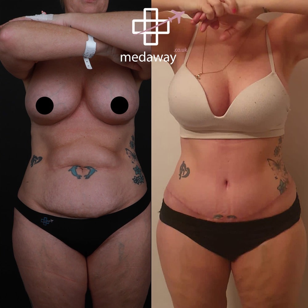 Medaway-Tummy-Tuck-2-min.jpeg
