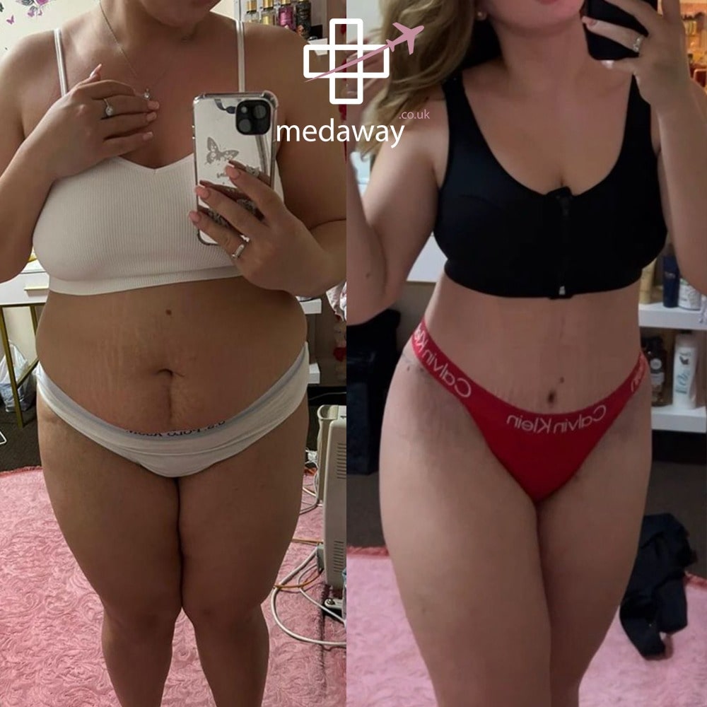 Medaway-Tummy-Tuck-3-min.jpeg