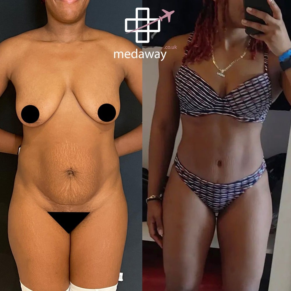 Medaway-Tummy-Tuck-4-min.jpeg