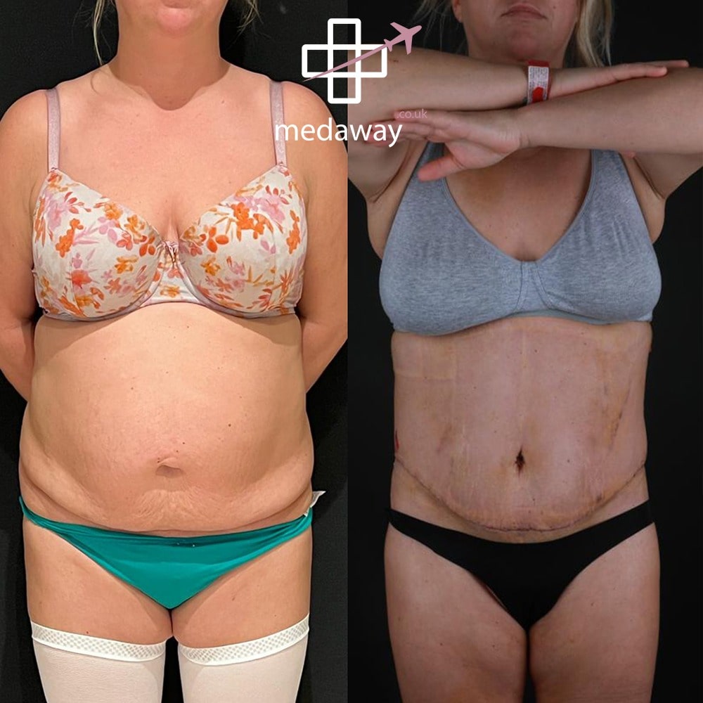 Medaway-Tummy-Tuck-6-min.jpeg