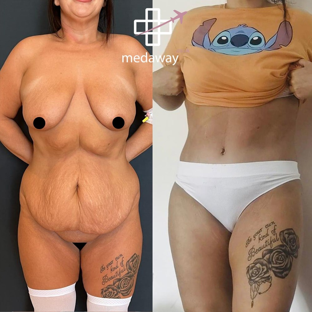 Medaway-Tummy-Tuck-8-min.jpeg