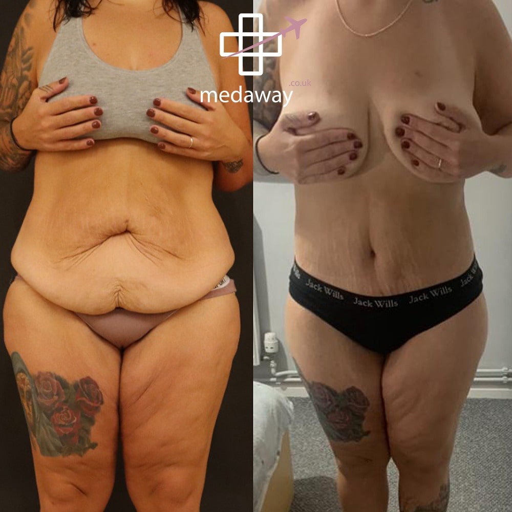 Medaway-Tummy-Tuck-9-min.jpeg