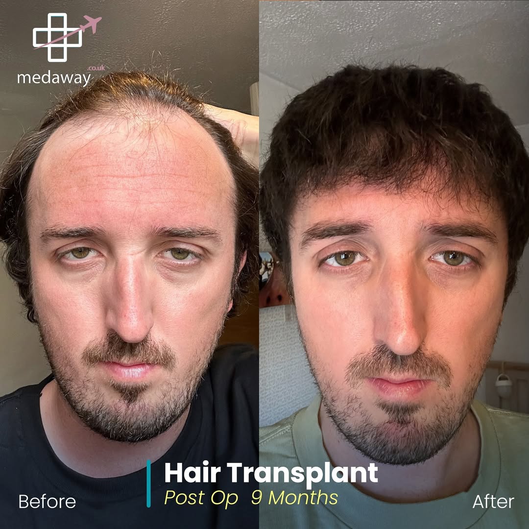 hair transplant before and after
