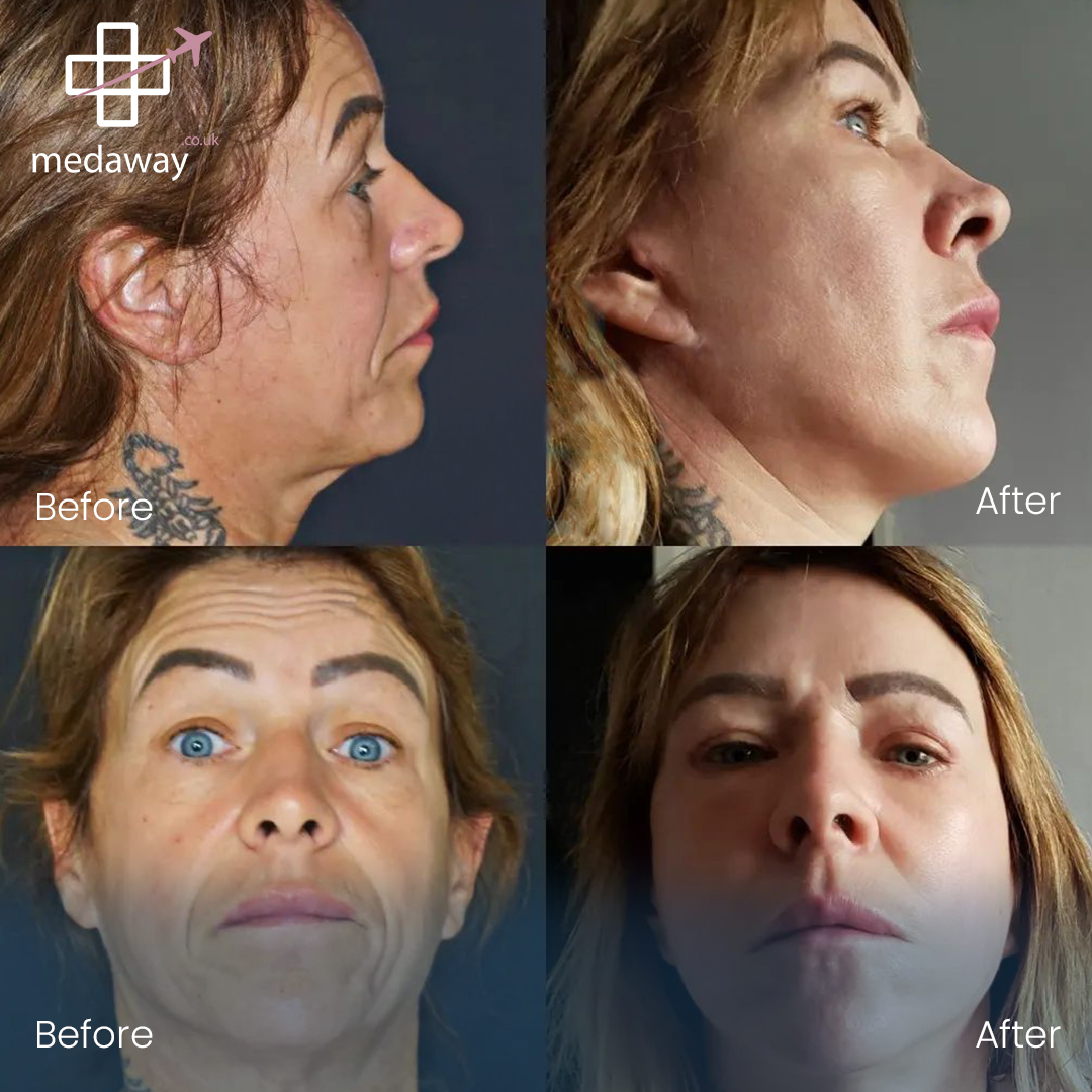 Face Lift in Turkey