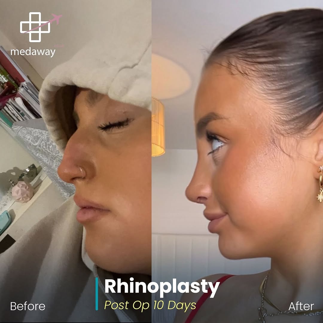 rhinoplasy before&after
