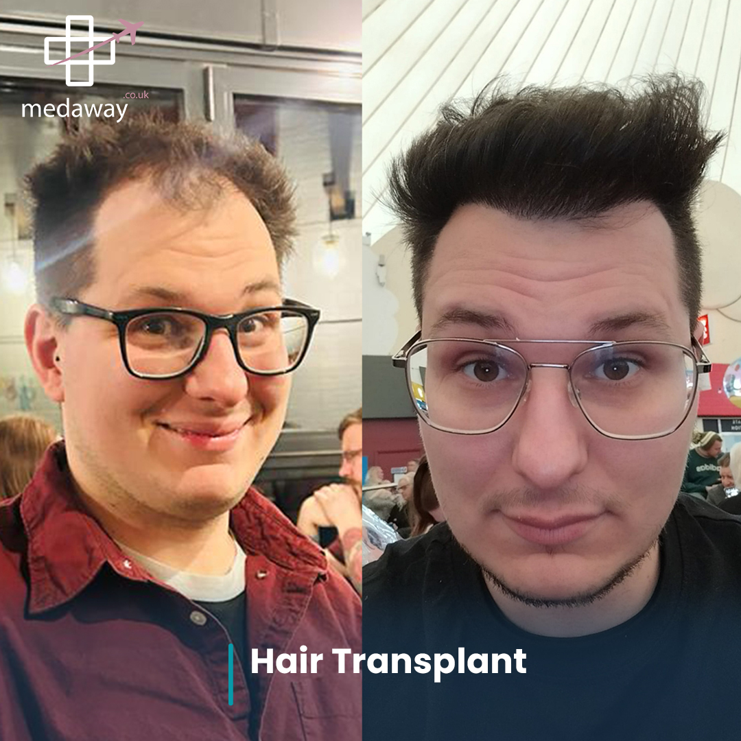 hair transplant before and after