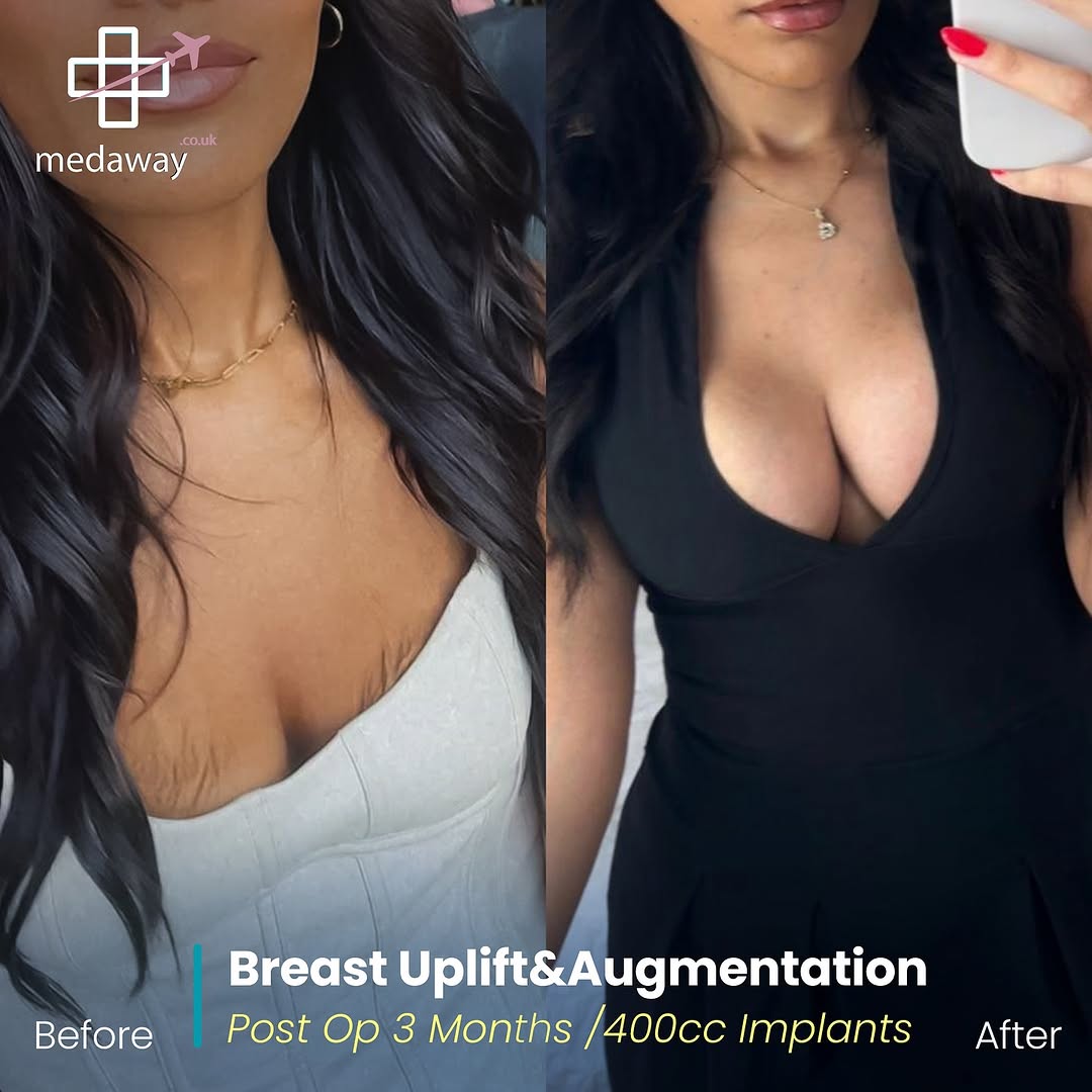 Boob Job