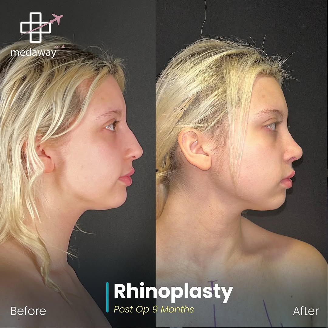 rhinoplasy before&after