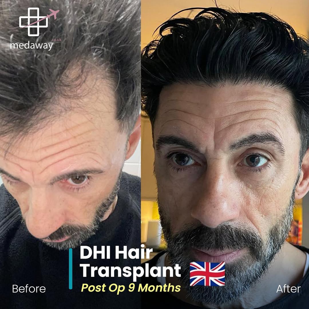 hair transplant before and after