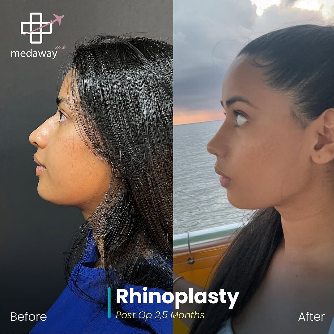 rhinoplasy before&after
