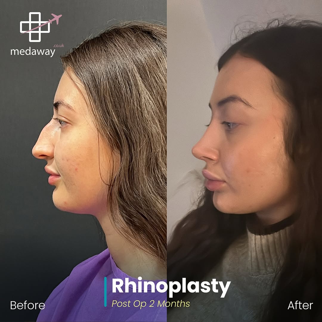 rhinoplasy before&after