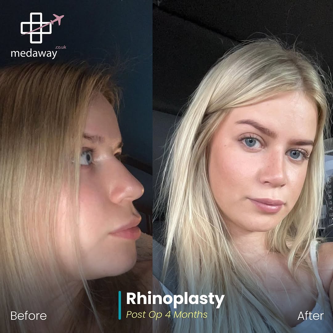 rhinoplasy before&after