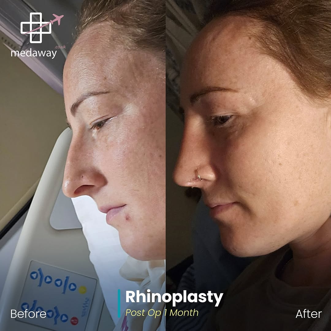 rhinoplasy before&after