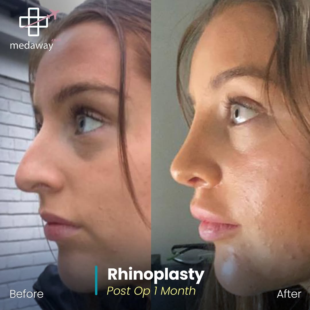rhinoplasy before&after
