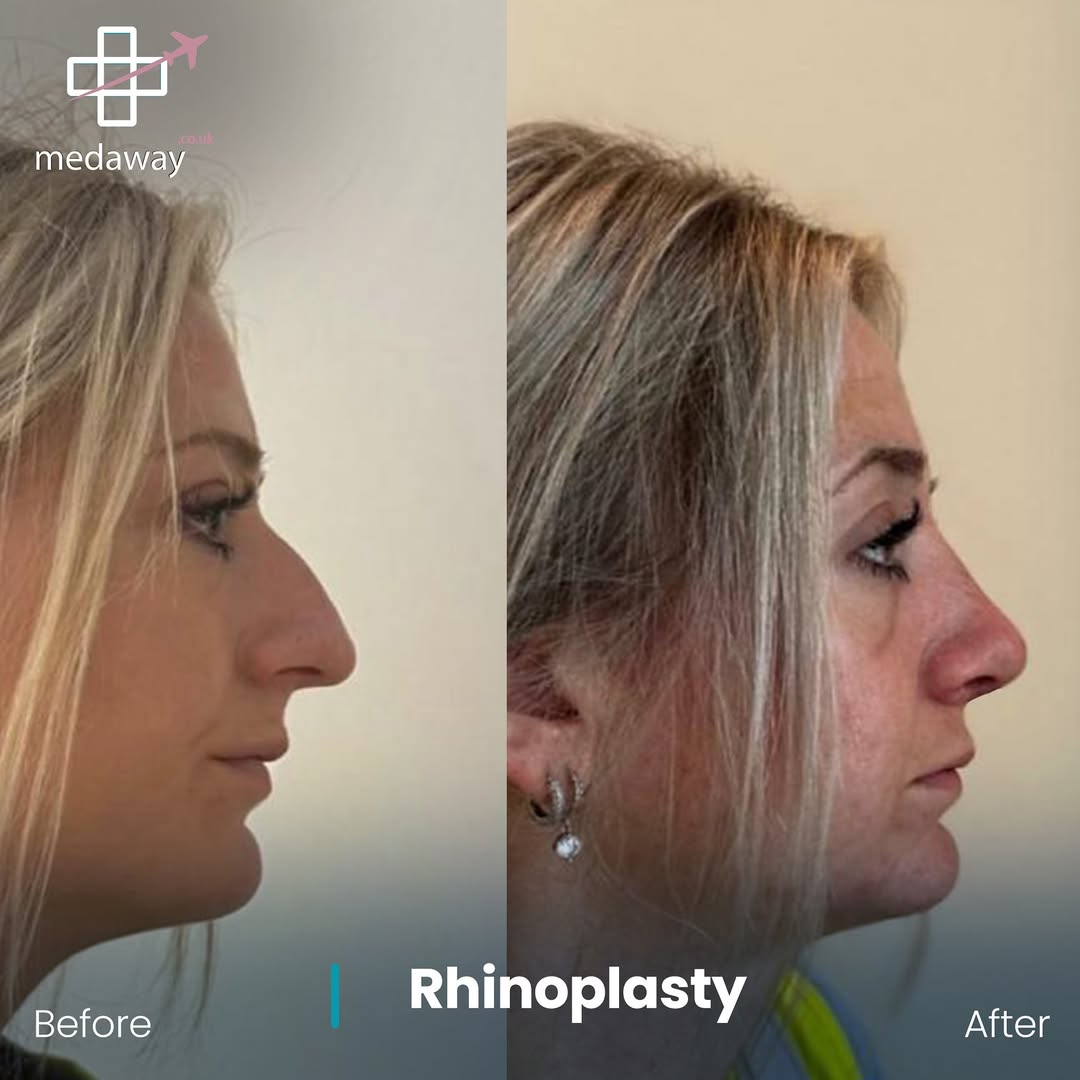 rhinoplasy before&after