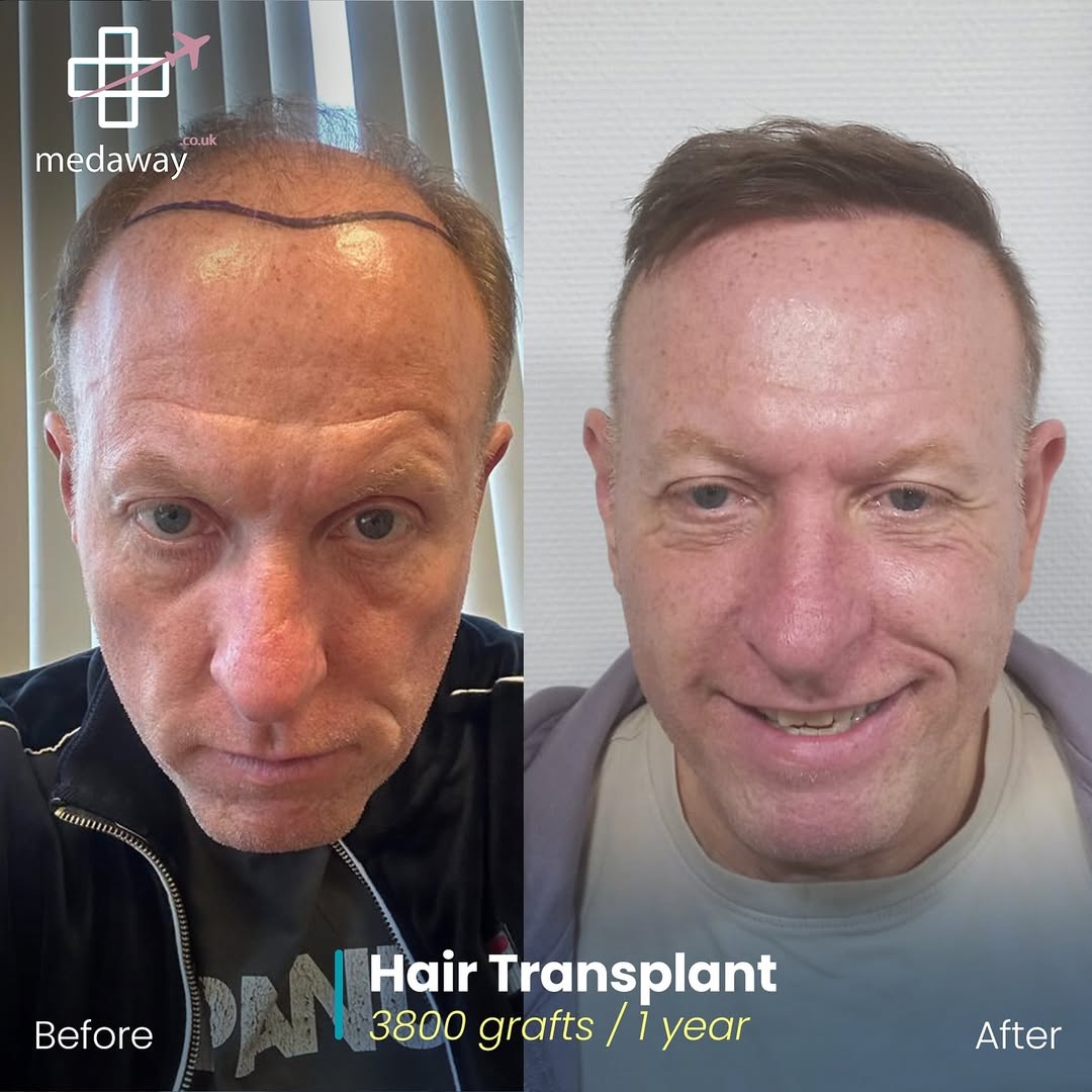 hair transplant before and after