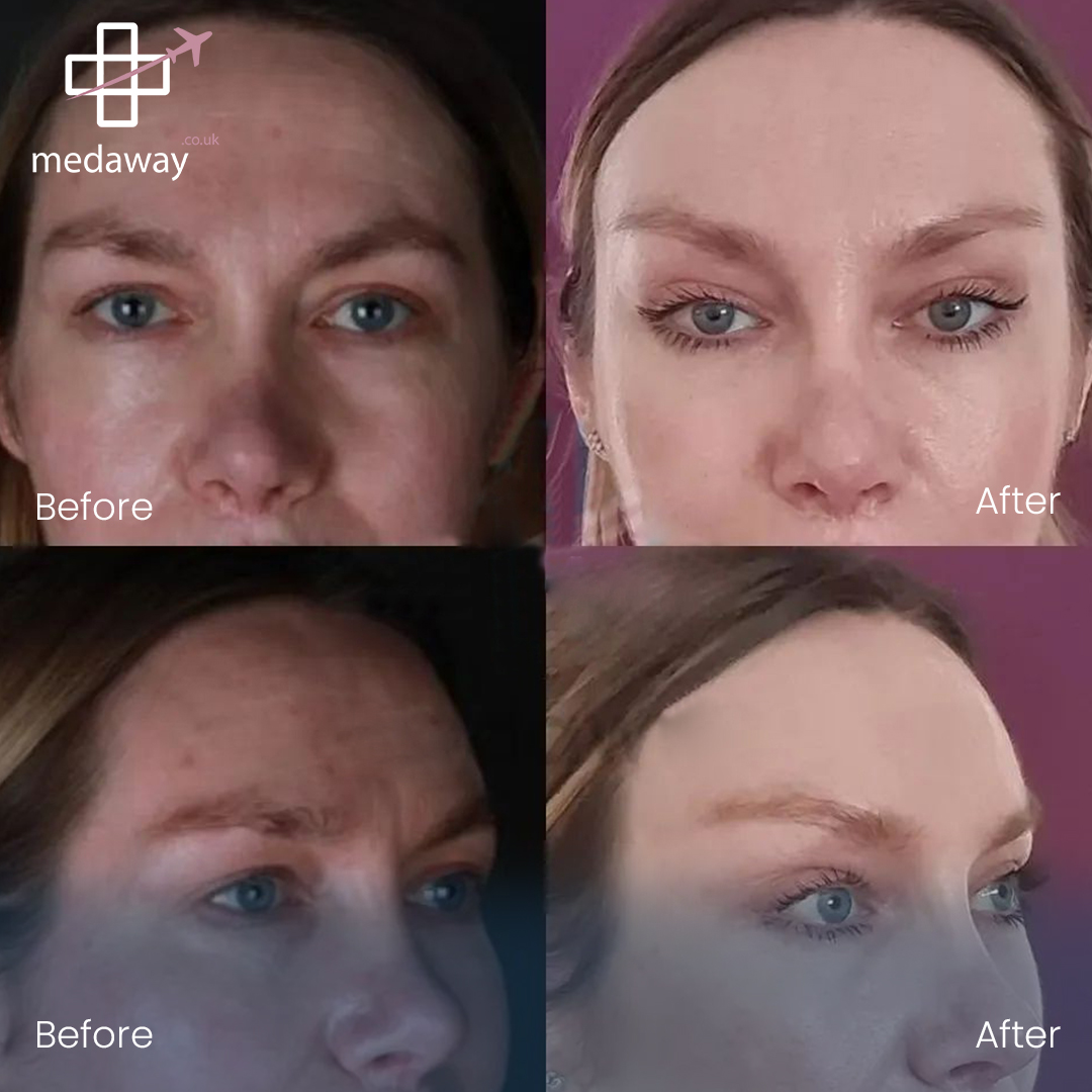 Face Lift in Turkey