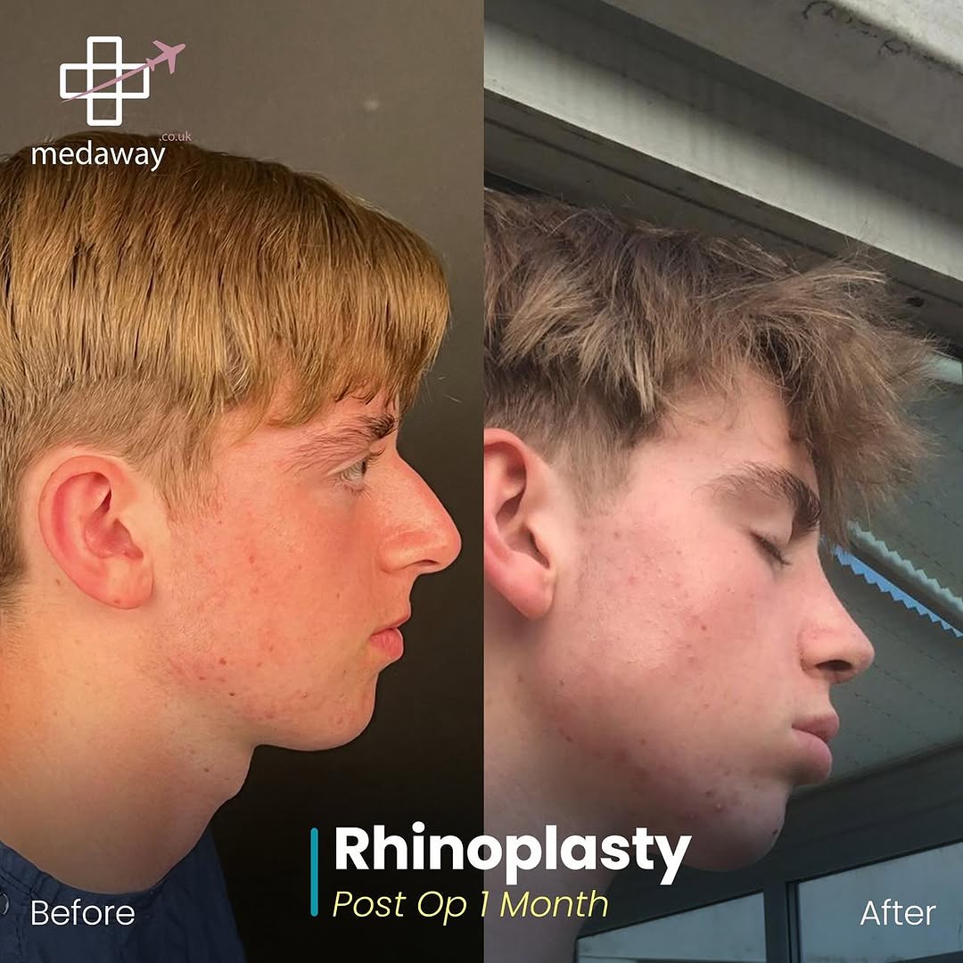 rhinoplasy before&after