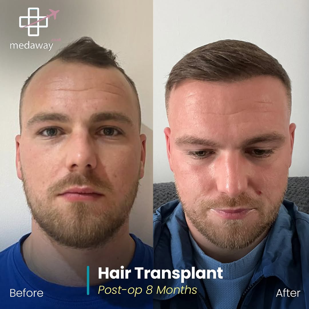 hair transplant before and after