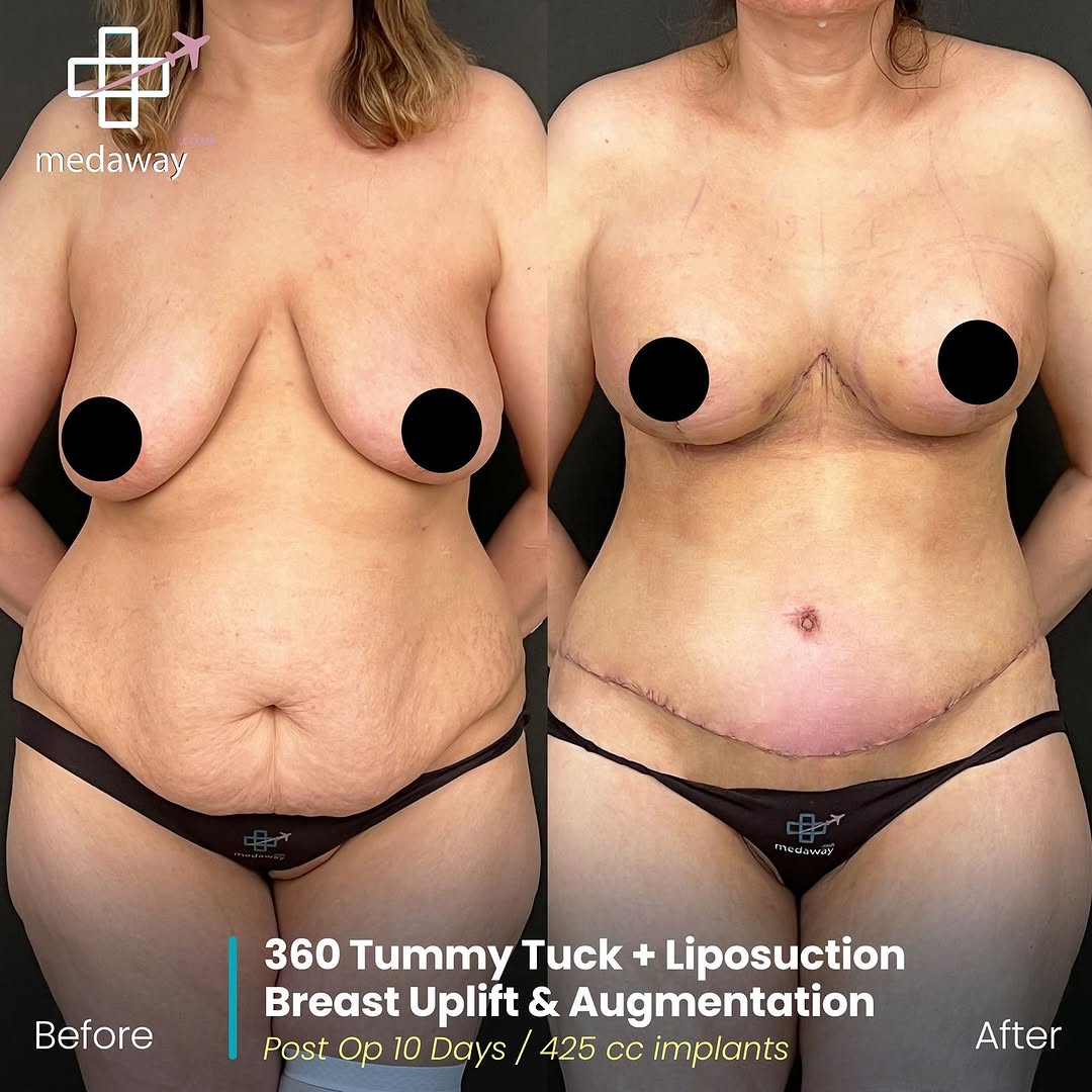 Mommy Makeover