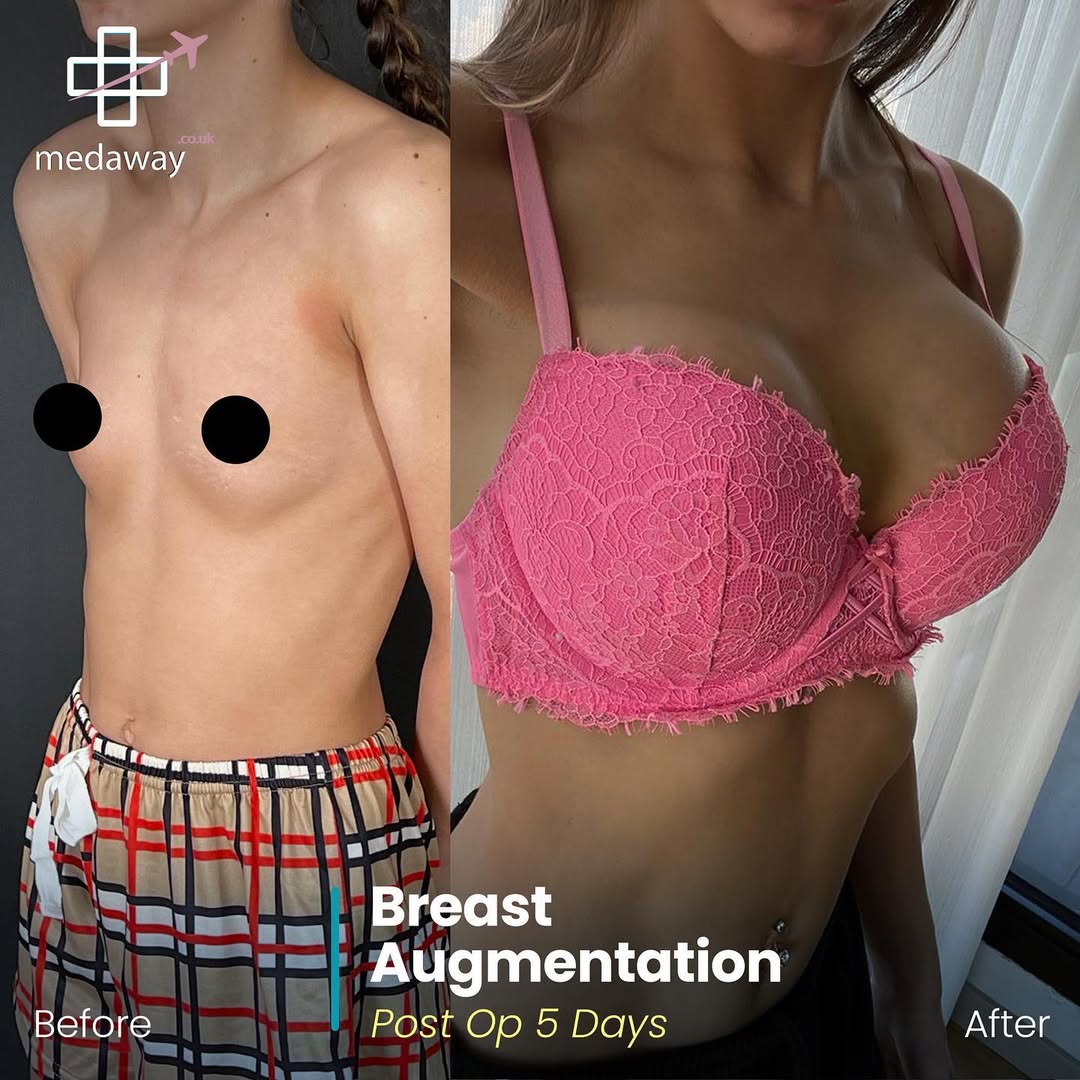 Boob Job