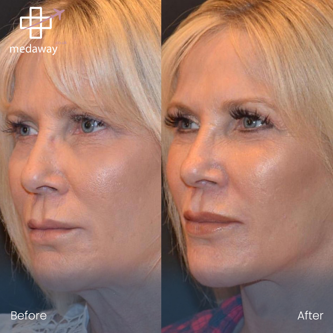 Face Lift in Turkey