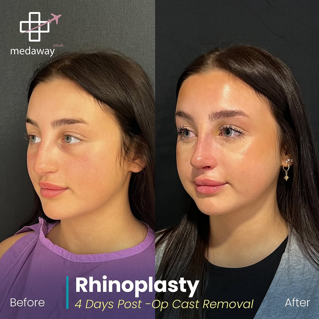 rhinoplasy before&after