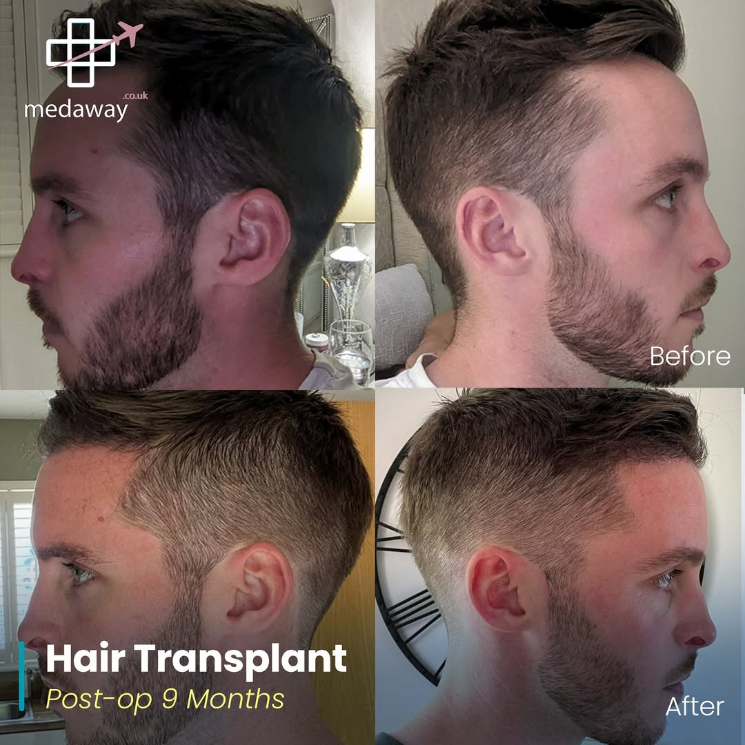 hair transplant before and after