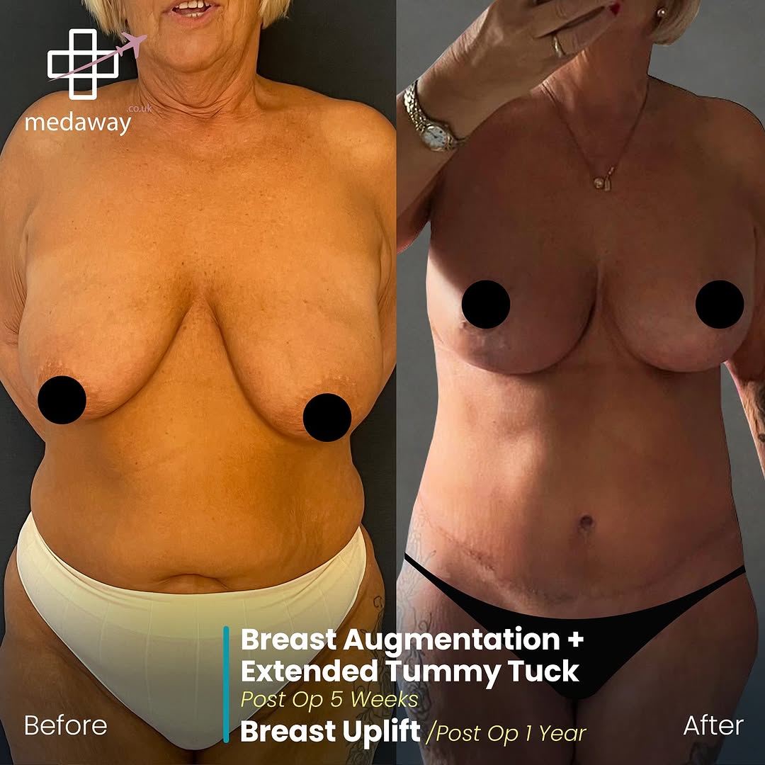 Mommy Makeover