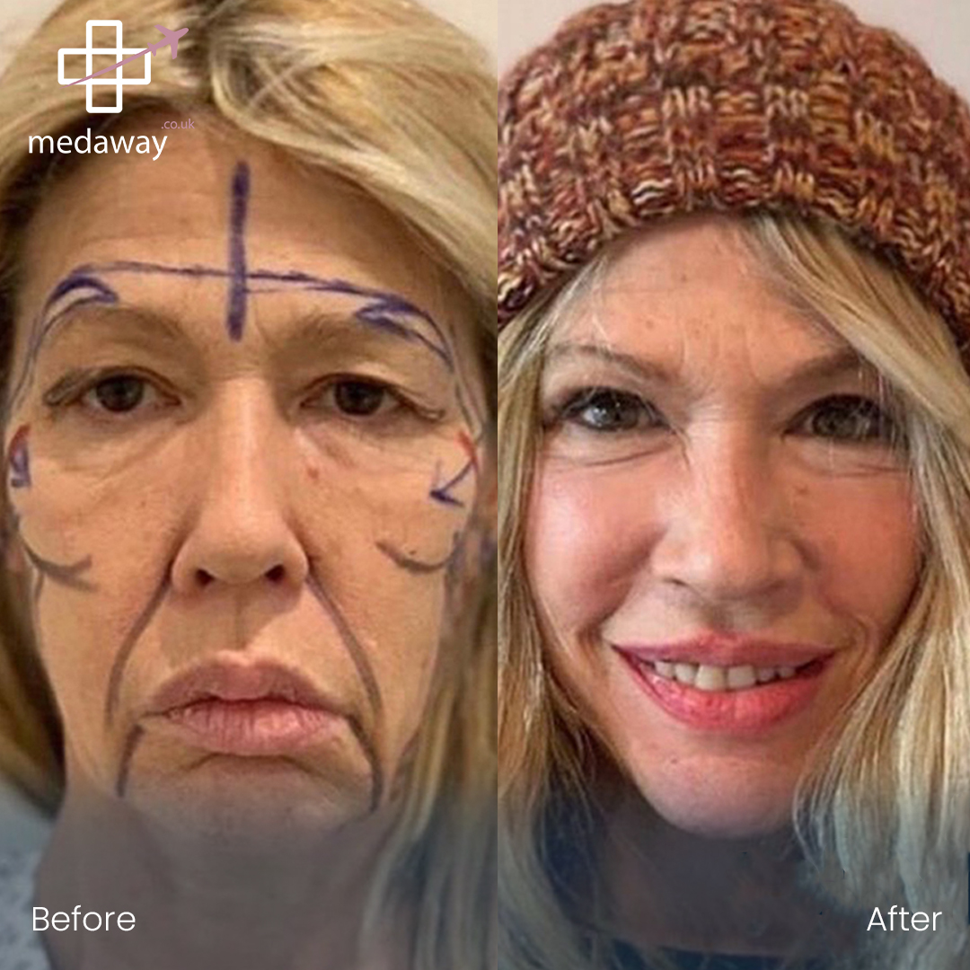 Face Lift in Turkey