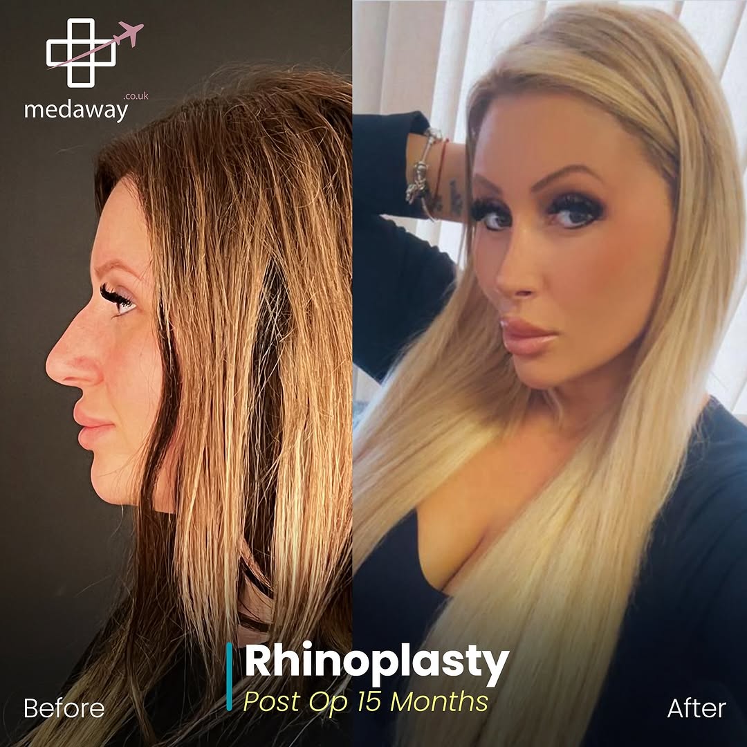 rhinoplasy before&after