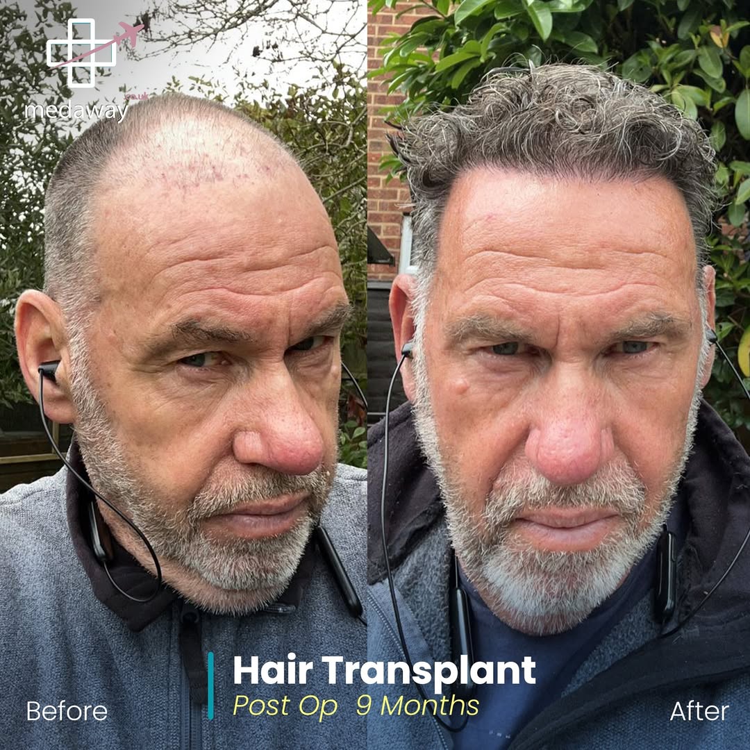hair transplant before and after