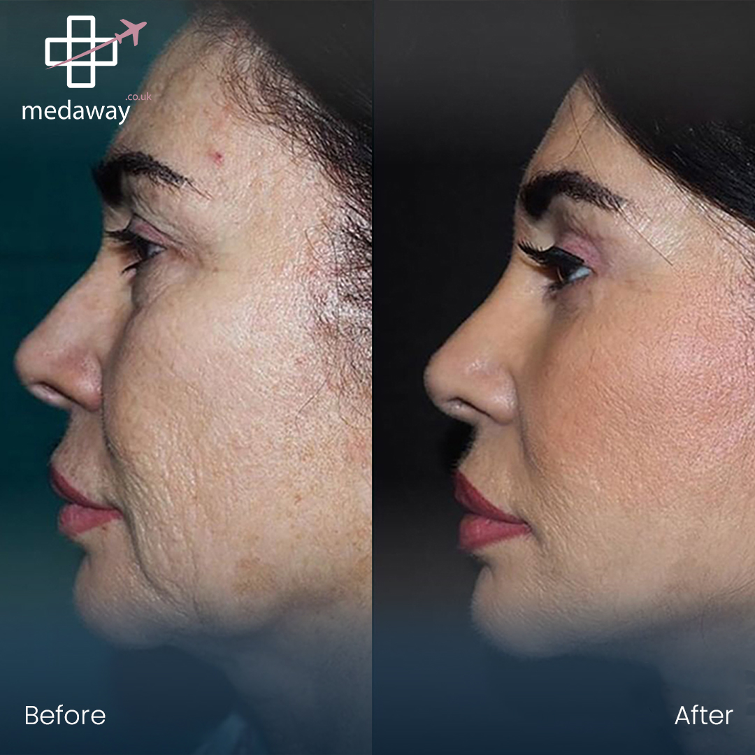 Face Lift in Turkey