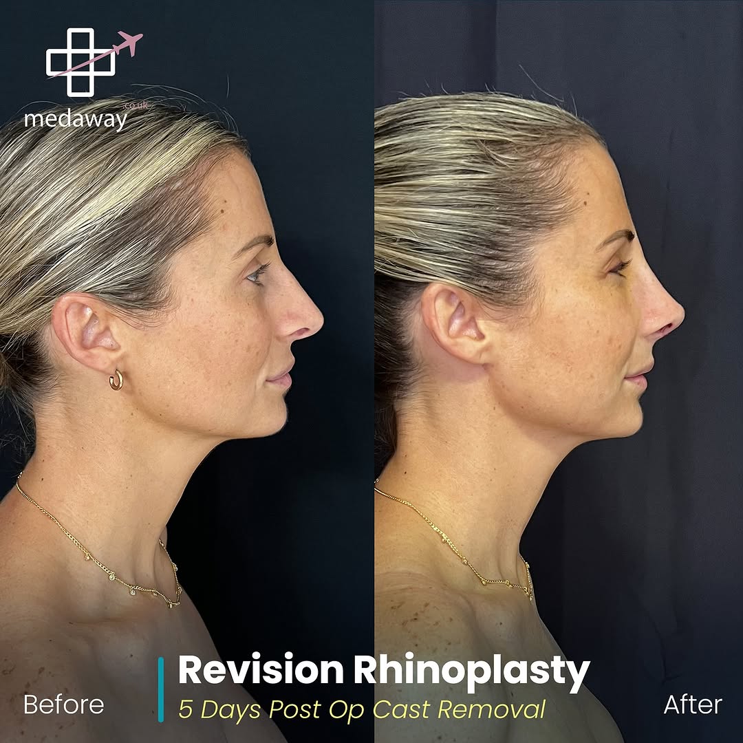 rhinoplasy before&after