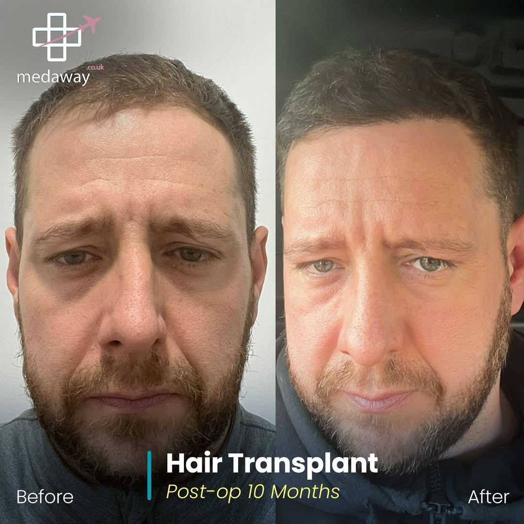 hair transplant before and after